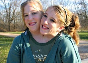 Cara Seks Kembar Siam Menurut Islam