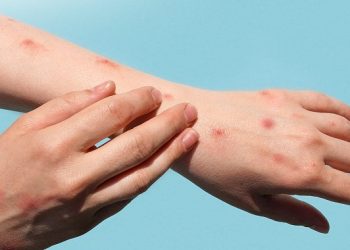 Cacar Monyet, Gejala dan Pencegahannya